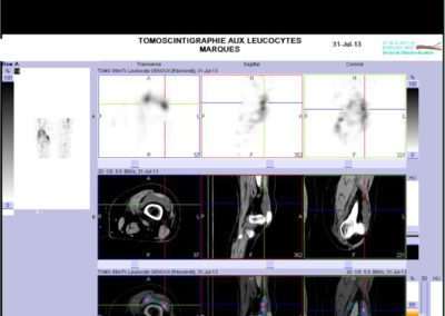 La scintigraphie aux leucocytes marqués - Scintigraphie Bordeaux Nord