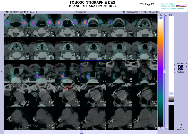 La scintigraphie des glandes parathyroïdes - Scintigraphie ...