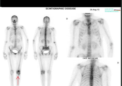La scintigraphie osseuse - Scintigraphie Bordeaux Nord