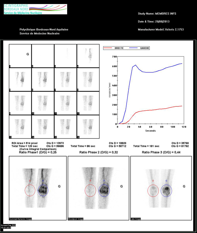 La scintigraphie osseuse - Scintigraphie Bordeaux Nord