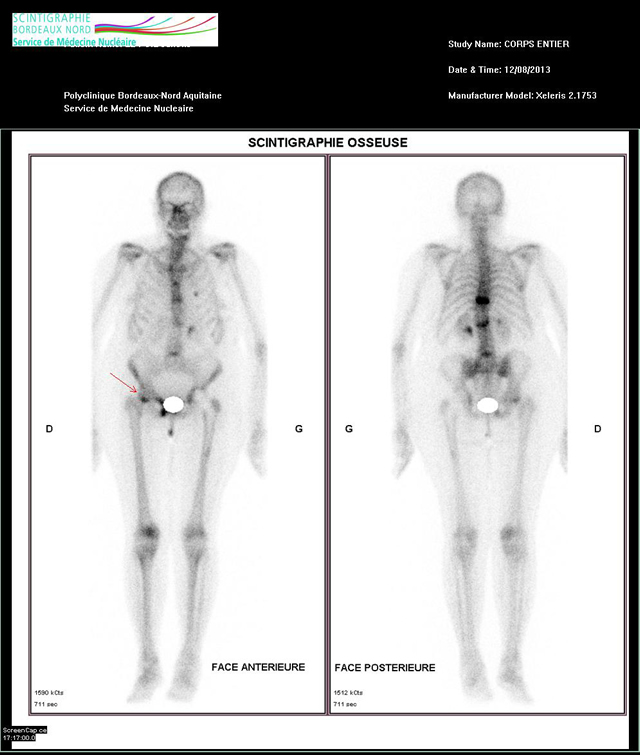 La scintigraphie osseuse - Scintigraphie Bordeaux Nord